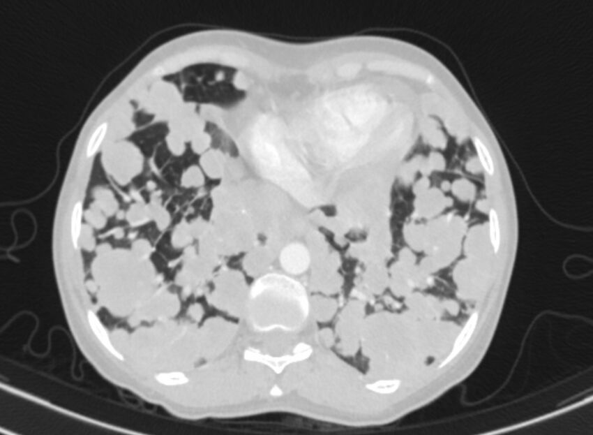 Cannonball metastases from breast cancer (Radiopaedia 91024-108569 Axial lung window 80).jpg