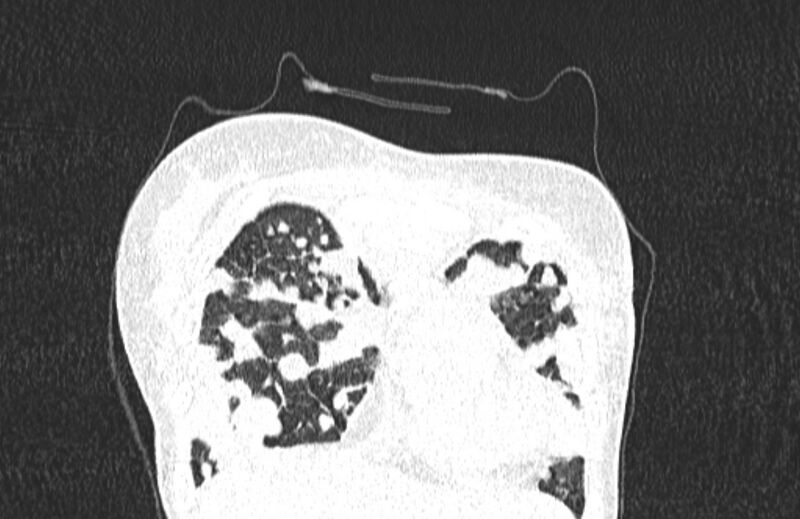 File:Cannonball metastases from breast cancer (Radiopaedia 91024-108569 Coronal lung window 21).jpg
