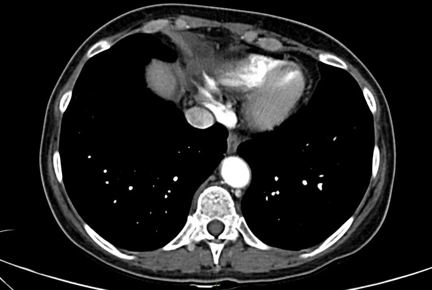 Carcinoid mesenteric tumor complicated by chylous ascites (Radiopaedia 76312-88926 A 2).jpg