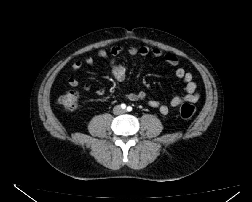 Carcinoid tumor with hepatic metastases (Radiopaedia 22651-22670 B 54).jpg