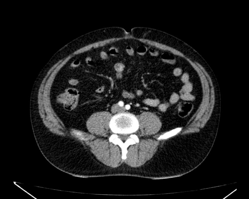 Carcinoid tumor with hepatic metastases (Radiopaedia 22651-22670 B 55).jpg