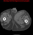 Cardiac perforation following transcatheter aortic valve implantation (Radiopaedia 23714-23863 B 30).png