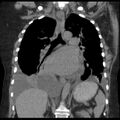 Cardiogenic pulmonary edema (Radiopaedia 29213-29609 Coronal non-contrast 24).jpg