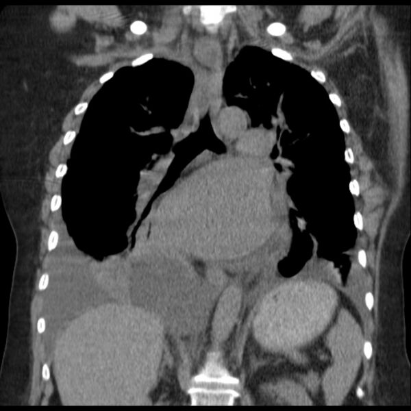 File:Cardiogenic pulmonary edema (Radiopaedia 29213-29609 Coronal non-contrast 24).jpg