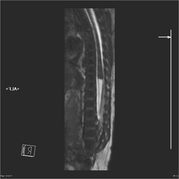 File:Caudal regression syndrome (Radiopaedia 23610-23727 Sagittal CISS 10).jpg
