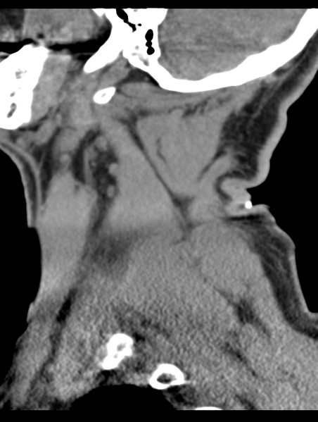 File:Cavernoma of cervical cord (Radiopaedia 50838-56346 B 12).png