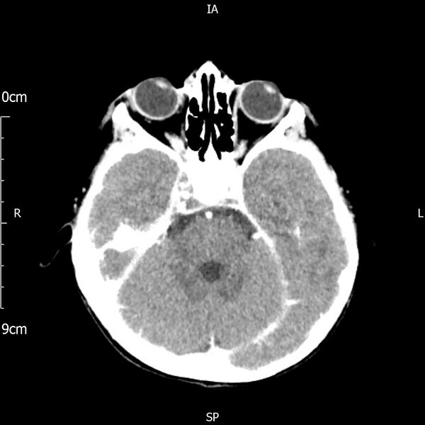 File:Cavernous sinus thrombosis (Radiopaedia 79414-92510 Axial Brain 76).jpg