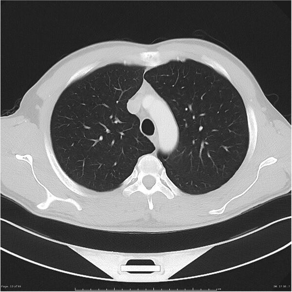 File:Cavitating lung cancer (Radiopaedia 25796-25945 Axial lung window 13).jpg