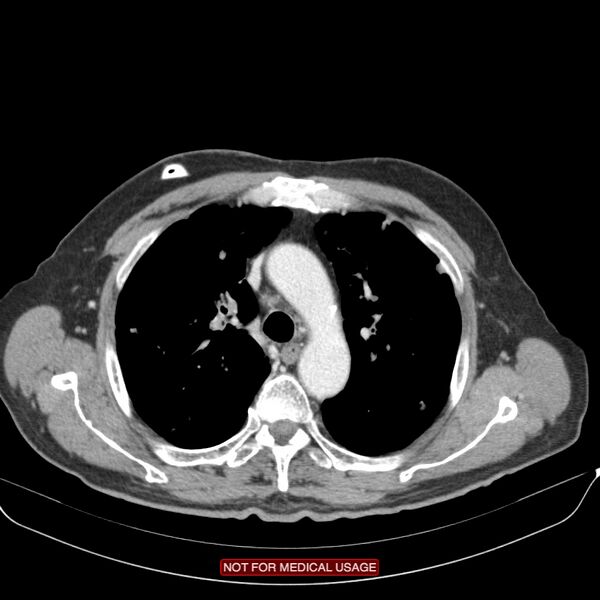File:Cavitating pulmonary metastases (Radiopaedia 24920-25184 B 7).jpg