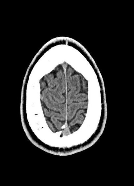 File:Cavum septum pellucidum and cavum vergae (Radiopaedia 77797-90060 Axial Brain Window 94).jpg