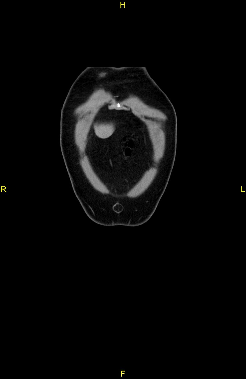 Cecal epiploic appendagitis (Radiopaedia 86047-102164 B 6).jpg
