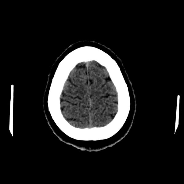File:Central nervous system Langerhans cell histiocytosis (Radiopaedia 65728-74878 Axial non-contrast 46).jpg