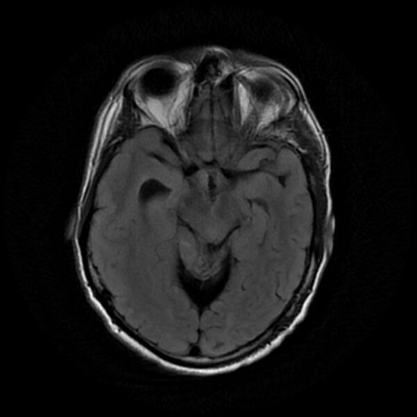 File:Central neurocytoma (Radiopaedia 67618-77021 Axial FLAIR 10).jpg