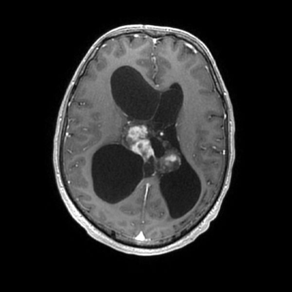 File:Central neurocytoma (Radiopaedia 67618-77021 Axial T1 C+ 17).jpg