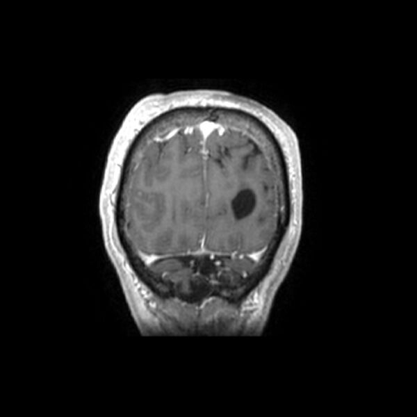 File:Central neurocytoma (Radiopaedia 67618-77021 Coronal T1 C+ 2).jpg