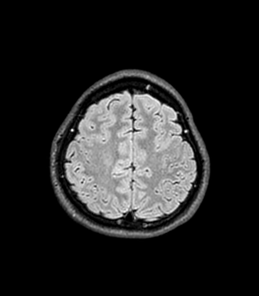Central neurocytoma (Radiopaedia 79320-92380 Axial FLAIR 78).jpg