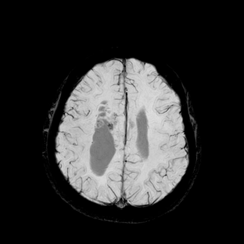 Central neurocytoma (Radiopaedia 79320-92380 Axial SWI 103).jpg