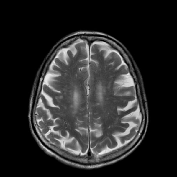 File:Cerebellar ataxia with neuropathy and vestibular areflexia syndrome (CANVAS) (Radiopaedia 74283-85159 Axial T2 16).jpg