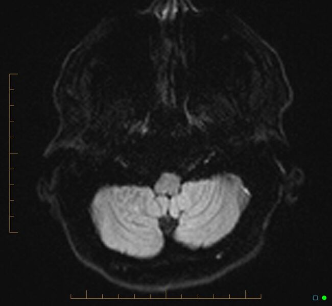 File:Cerebellar gangliocytoma (Radiopaedia 65377-74422 Axial DWI 5).jpg