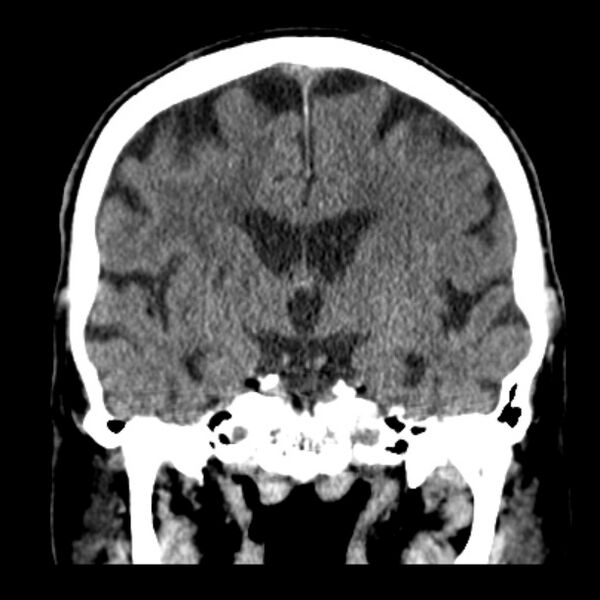 File:Cerebellar hemorrhage (Radiopaedia 27193-27359 Coronal non-contrast 29).jpg