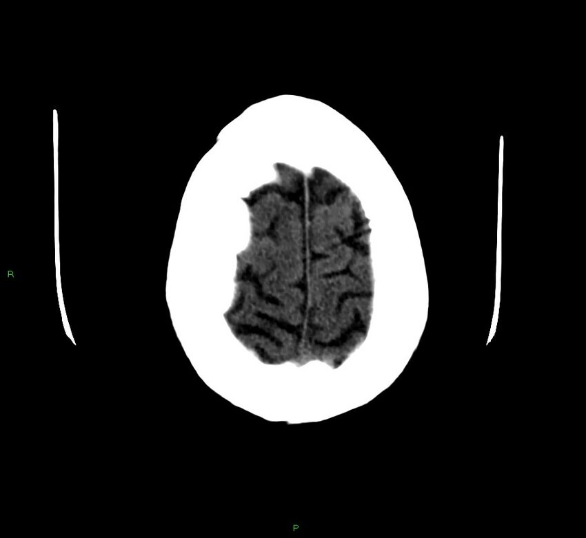 Cerebellar hemorrhage (Radiopaedia 58792-66026 Axial non-contrast 7).jpg
