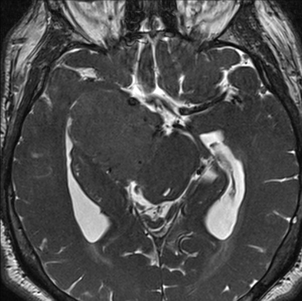 File:Cerebellopontine angle meningioma (Radiopaedia 24459-24764 I 42).jpg