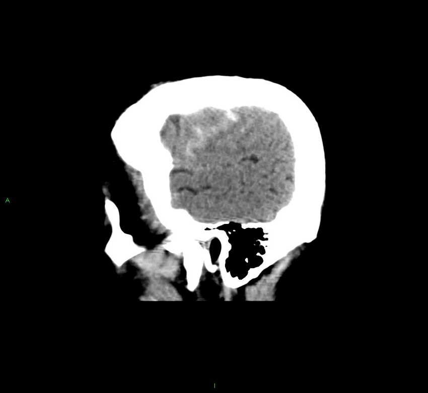 Cerebral amyloid angiopathy-associated lobar intracerebral hemorrhage (Radiopaedia 58376-65511 C 46).jpg