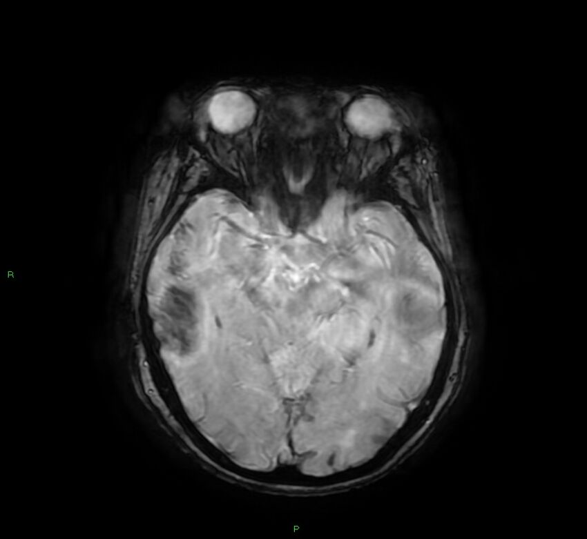 Cerebral amyloid angiopathy-associated lobar intracerebral hemorrhage (Radiopaedia 58378-65517 Axial SWI 29).jpg