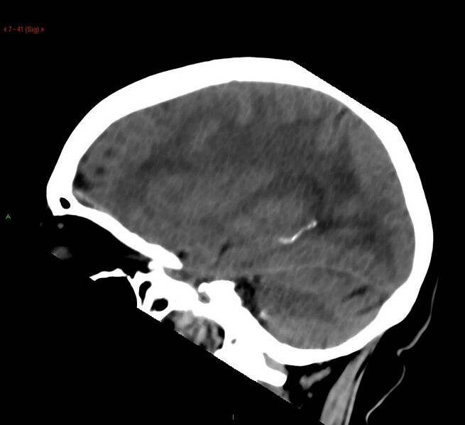 File:Cerebral amyloid angiopathy-associated lobar intracerebral hemorrhage (Radiopaedia 58378-65518 C 41).jpg