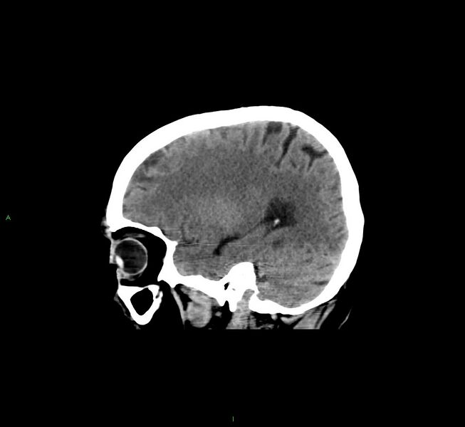 File:Cerebral amyloid angiopathy-associated lobar intracerebral hemorrhage (Radiopaedia 58529-65681 B 15).jpg