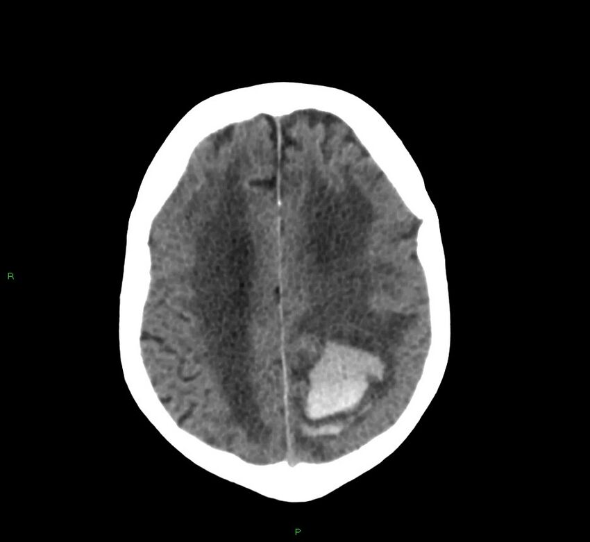 Cerebral amyloid angiopathy-associated lobar intracerebral hemorrhage (Radiopaedia 58530-65688 Axial non-contrast 14).jpg