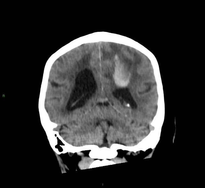 File:Cerebral amyloid angiopathy-associated lobar intracerebral hemorrhage (Radiopaedia 58530-65688 Coronal non-contrast 25).jpg