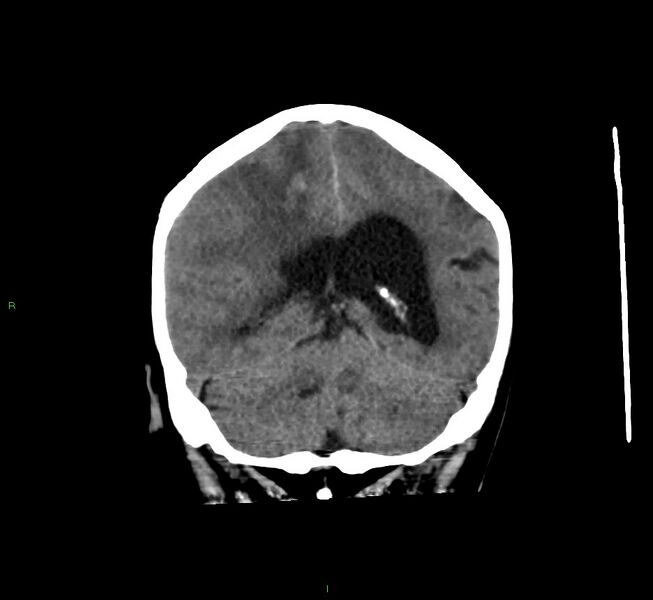 File:Cerebral amyloid angiopathy-associated lobar intracerebral hemorrhage (Radiopaedia 58560-65723 Coronal non-contrast 26).jpg