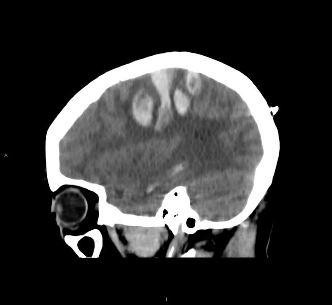 File:Cerebral amyloid angiopathy-associated lobar intracerebral hemorrhage (Radiopaedia 58566-65730 C 14).jpg