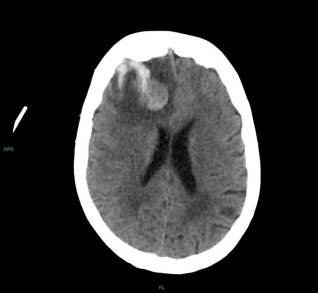 File:Cerebral amyloid angiopathy-associated lobar intracerebral hemorrhage (Radiopaedia 58569-65734 Axial non-contrast 27).jpg