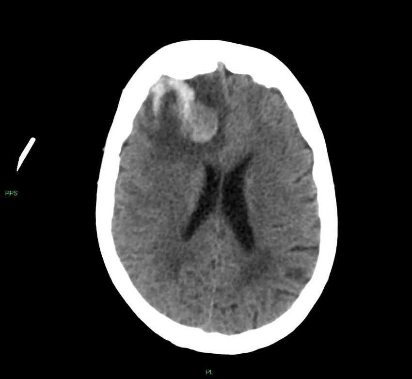 Cerebral amyloid angiopathy-associated lobar intracerebral hemorrhage (Radiopaedia 58569-65734 Axial non-contrast 27).jpg