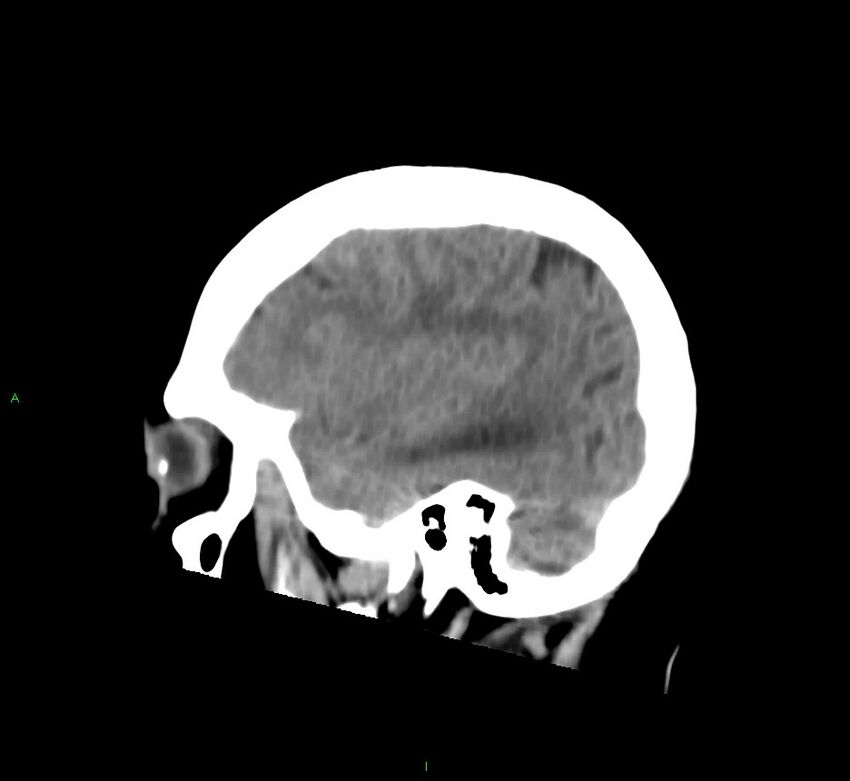 Cerebral amyloid angiopathy-associated lobar intracerebral hemorrhage (Radiopaedia 58752-65973 C 14).jpg