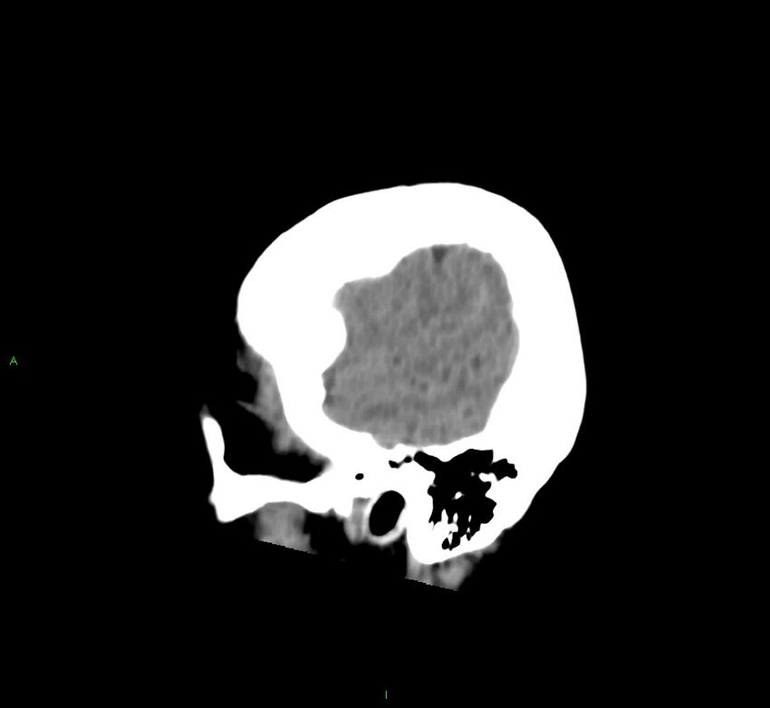 Cerebral amyloid angiopathy-associated lobar intracerebral hemorrhage (Radiopaedia 58752-65973 C 9).jpg
