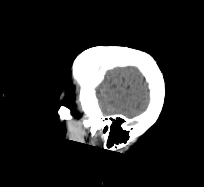 File:Cerebral amyloid angiopathy-associated lobar intracerebral hemorrhage (Radiopaedia 58756-65977 C 50).jpg