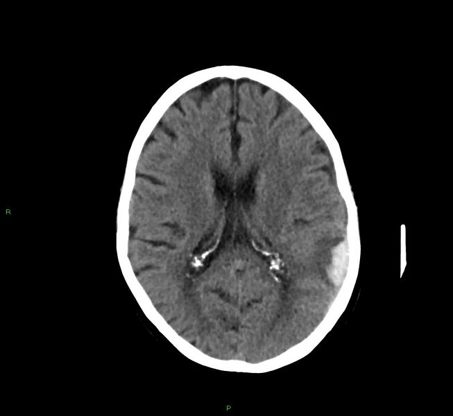 File:Cerebral amyloid angiopathy-associated lobar intracerebral hemorrhage (Radiopaedia 58757-65978 Axial non-contrast 24).jpg