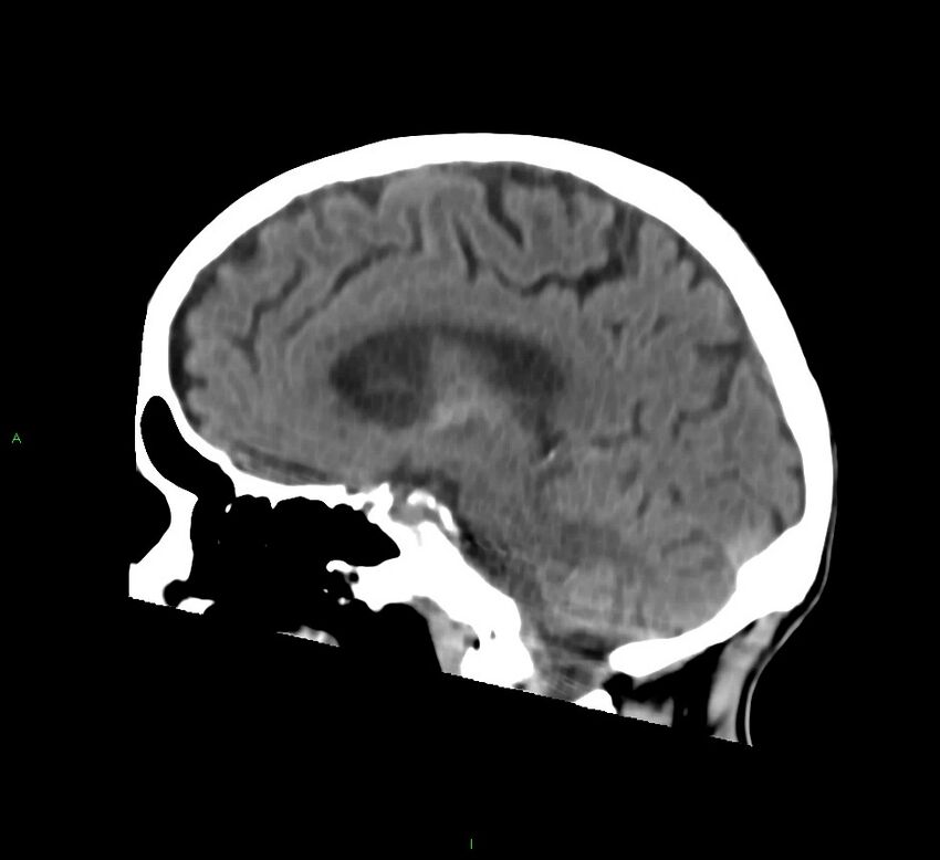 Cerebral amyloid angiopathy-associated lobar intracerebral hemorrhage (Radiopaedia 58758-65980 C 31).jpg