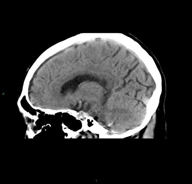 File:Cerebral amyloid angiopathy-associated lobar intracerebral hemorrhage (Radiopaedia 59356-66716 C 32).jpg