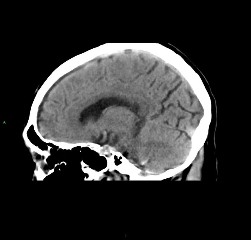 Cerebral amyloid angiopathy-associated lobar intracerebral hemorrhage (Radiopaedia 59356-66716 C 32).jpg