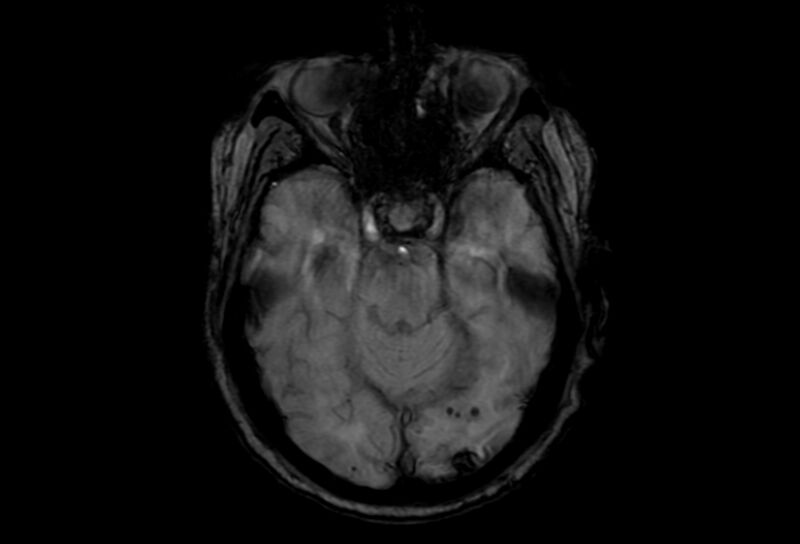 File:Cerebral amyloid angiopathy (Radiopaedia 86671-102792 Axial Gradient Echo 38).jpg