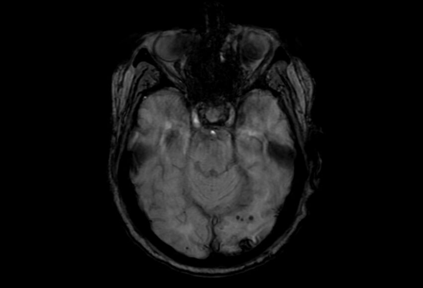 Cerebral amyloid angiopathy (Radiopaedia 86671-102792 Axial Gradient Echo 38).jpg