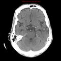 Cerebral and orbital tuberculomas (Radiopaedia 13308-13310 B 11).jpg