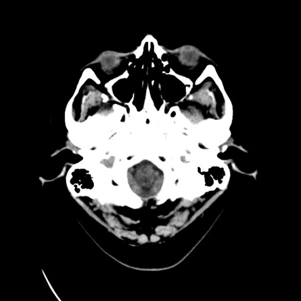 File:Cerebral arteriovenous malformation (Radiopaedia 43729-47189 Axial non-contrast 2).jpg