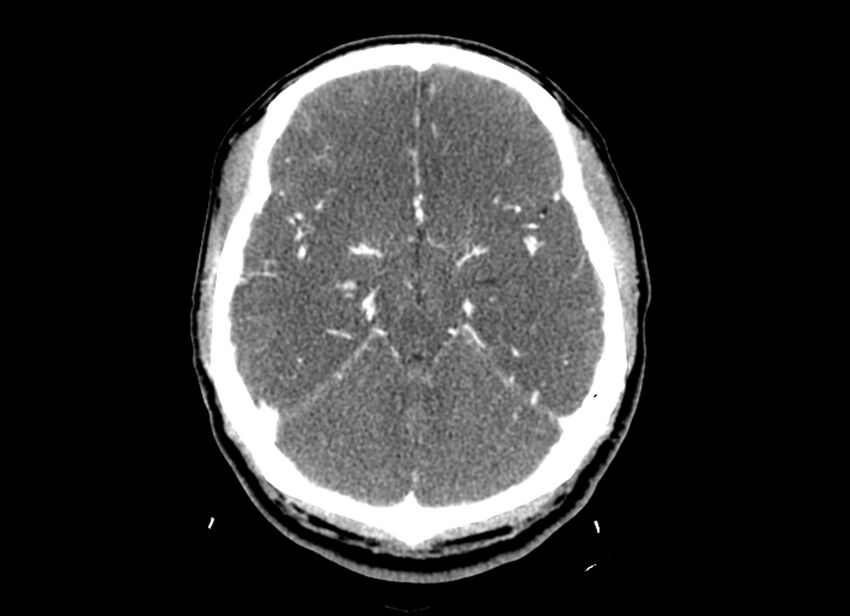 Cerebral edema (Radiopaedia 82519-96661 B 37).jpg