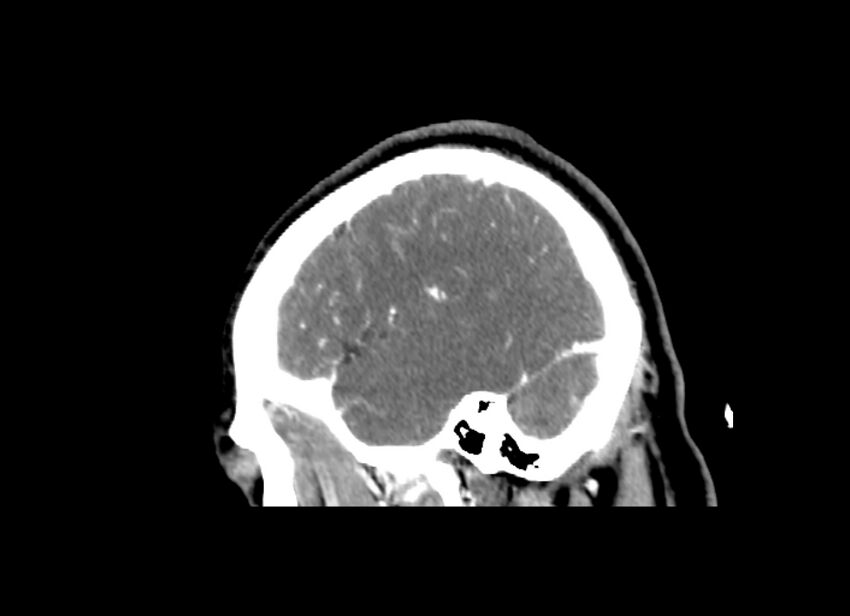 Cerebral edema (Radiopaedia 82519-96661 D 43).jpg