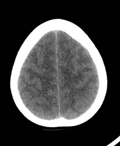 File:Cerebral edema due to severe hyponatremia (Radiopaedia 89826-106937 Axial non-contrast 75).jpg